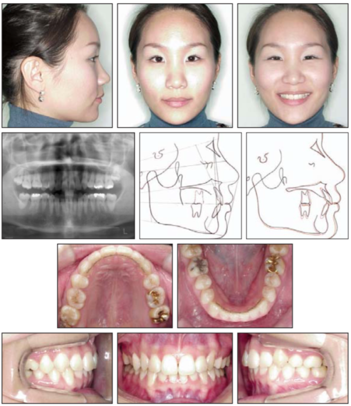Elastici ortodontici: consigli pratici per l'uso - Dentisti Vignato Vicenza