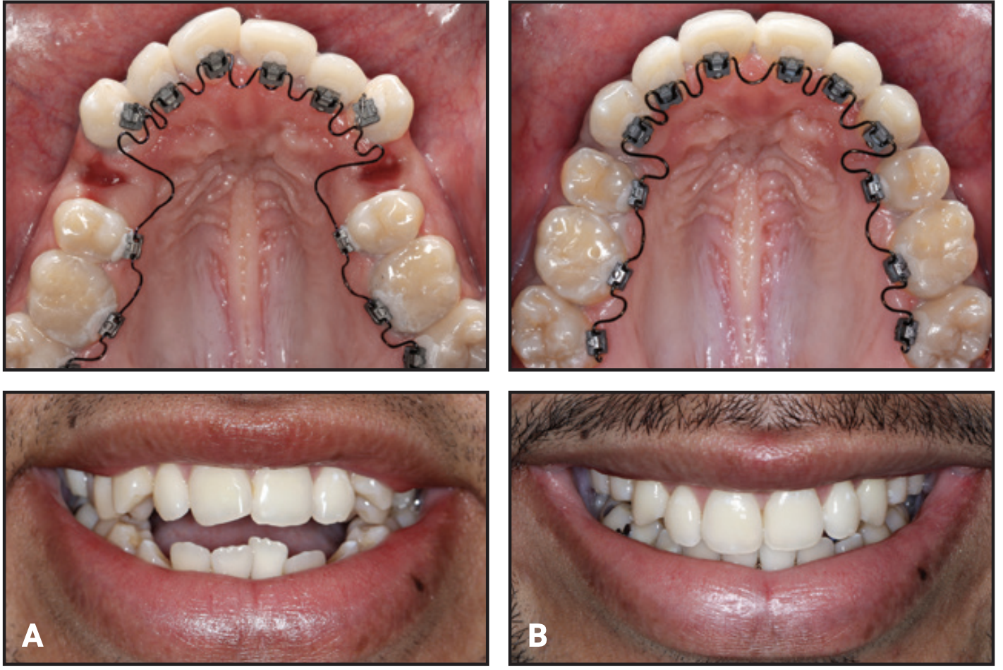 Lingual Orthodontics Redefined with Automation and FrictionFree